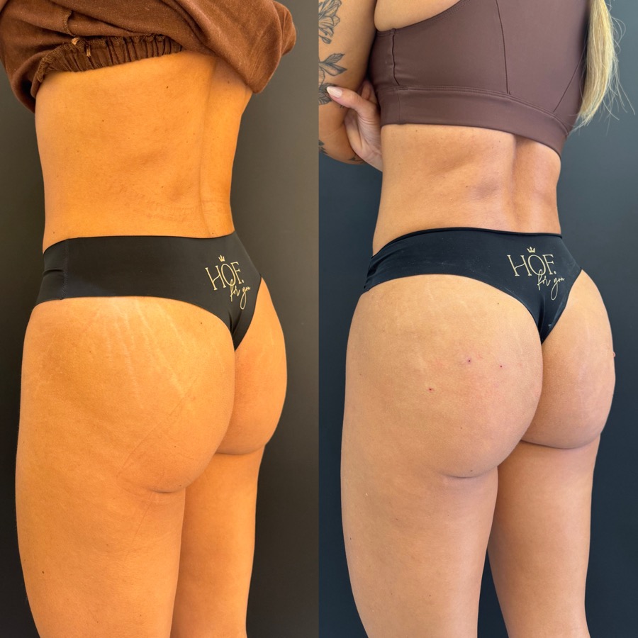 Resultado antes e depois BB UP