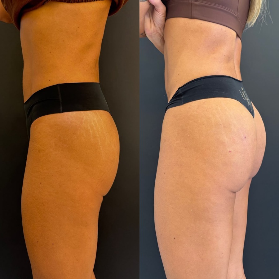 Resultado antes e depois BB UP
