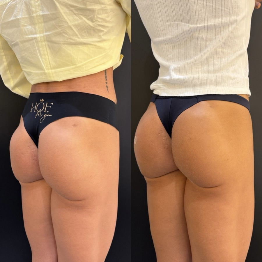 Resultado antes e depois BB UP