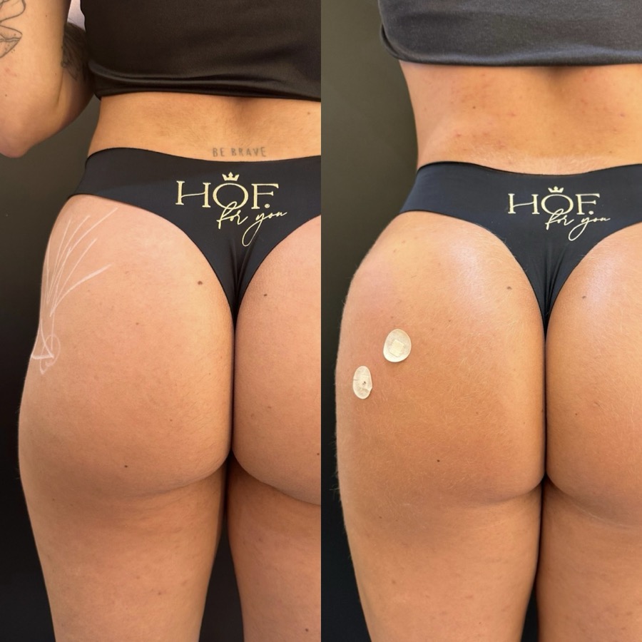 Resultado antes e depois BB UP